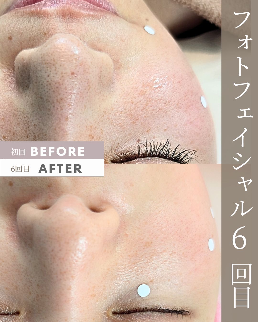 フォトフェイシャル 6回目 ビフォーアフター