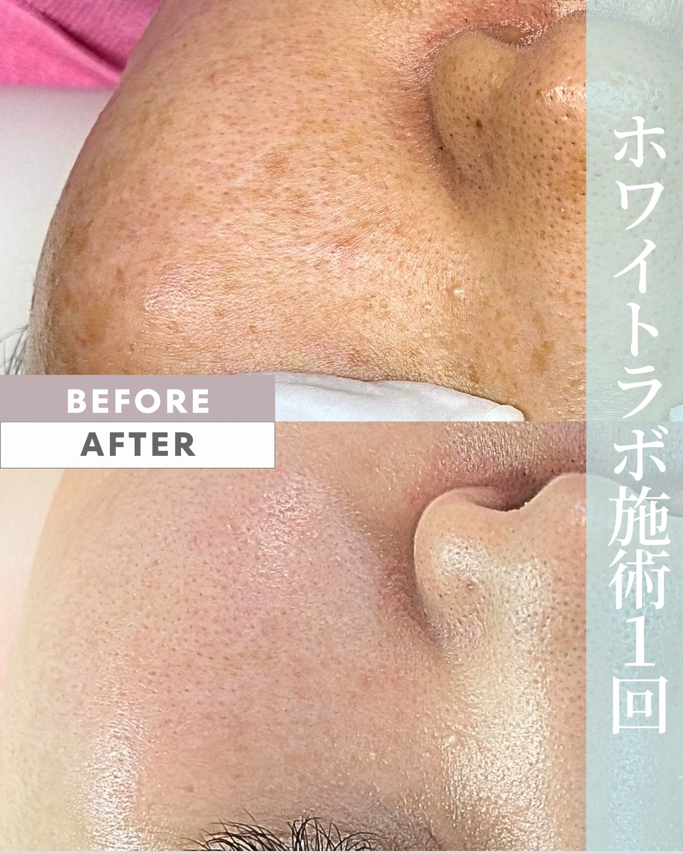 ホワイトラボ 1回目 ビフォーアフター